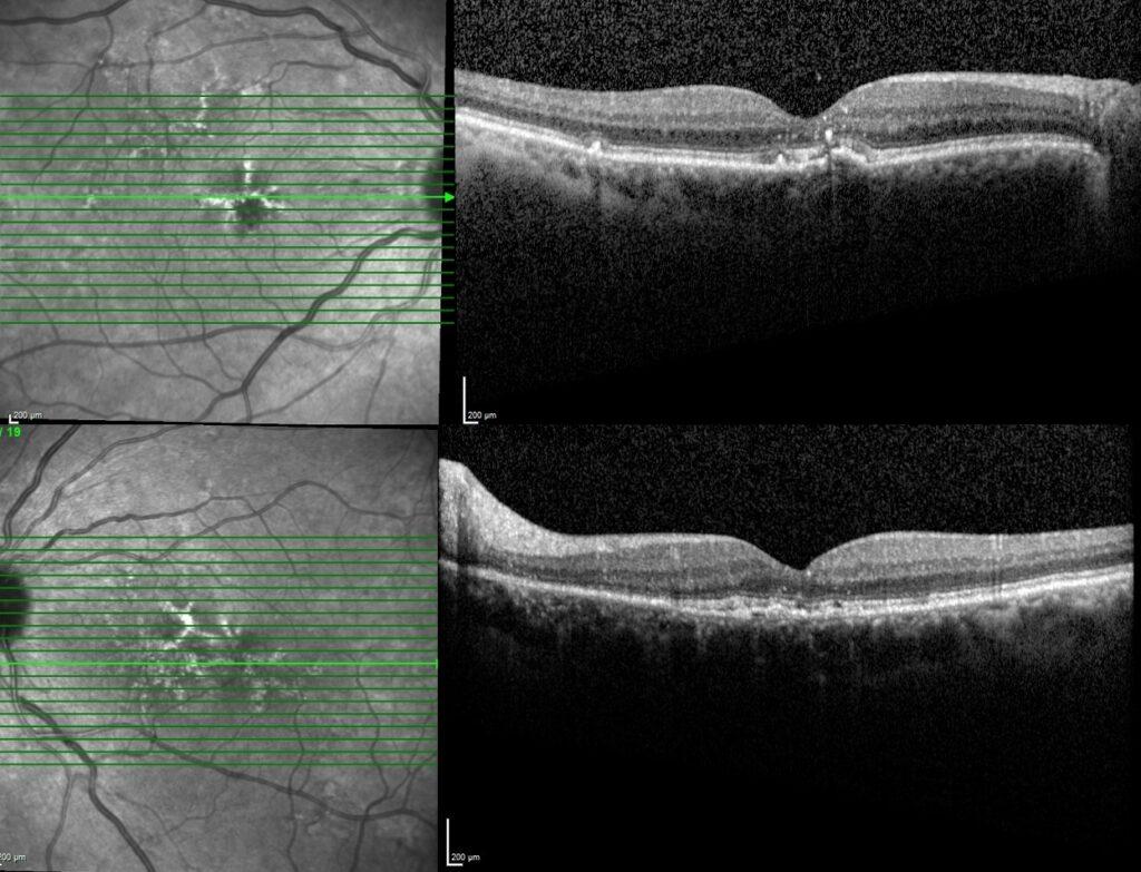 Butterfly-Shaped Pattern Dystrophy - RetinaRA