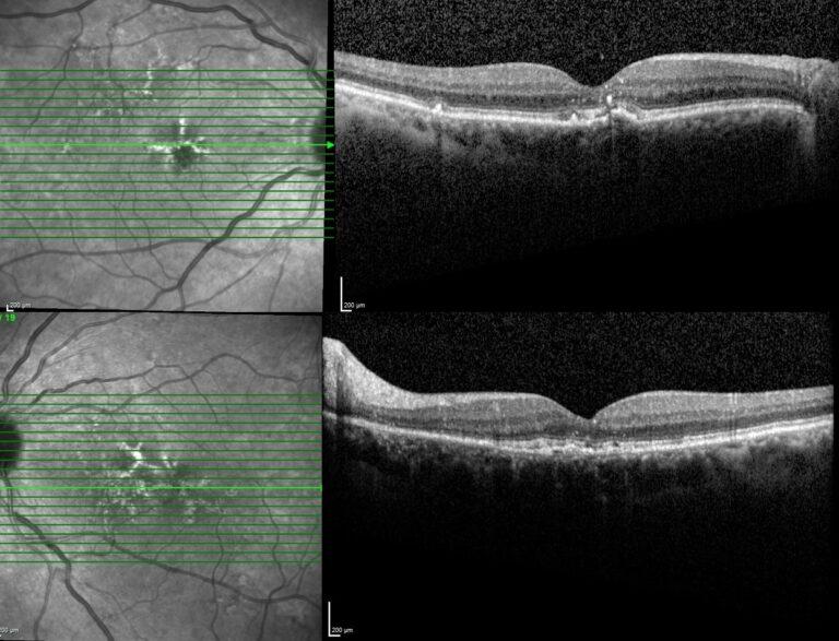 Butterfly-Shaped Pattern Dystrophy - RetinaRA