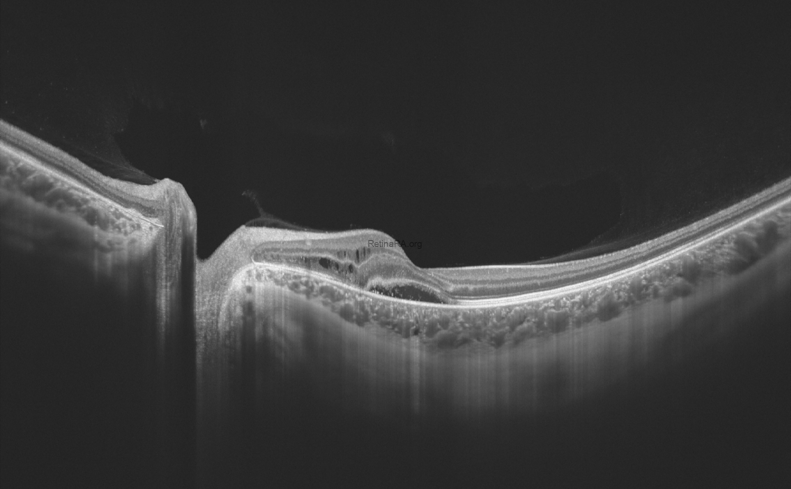 punctate-inner-choroidopathy-CNV-OCT-1