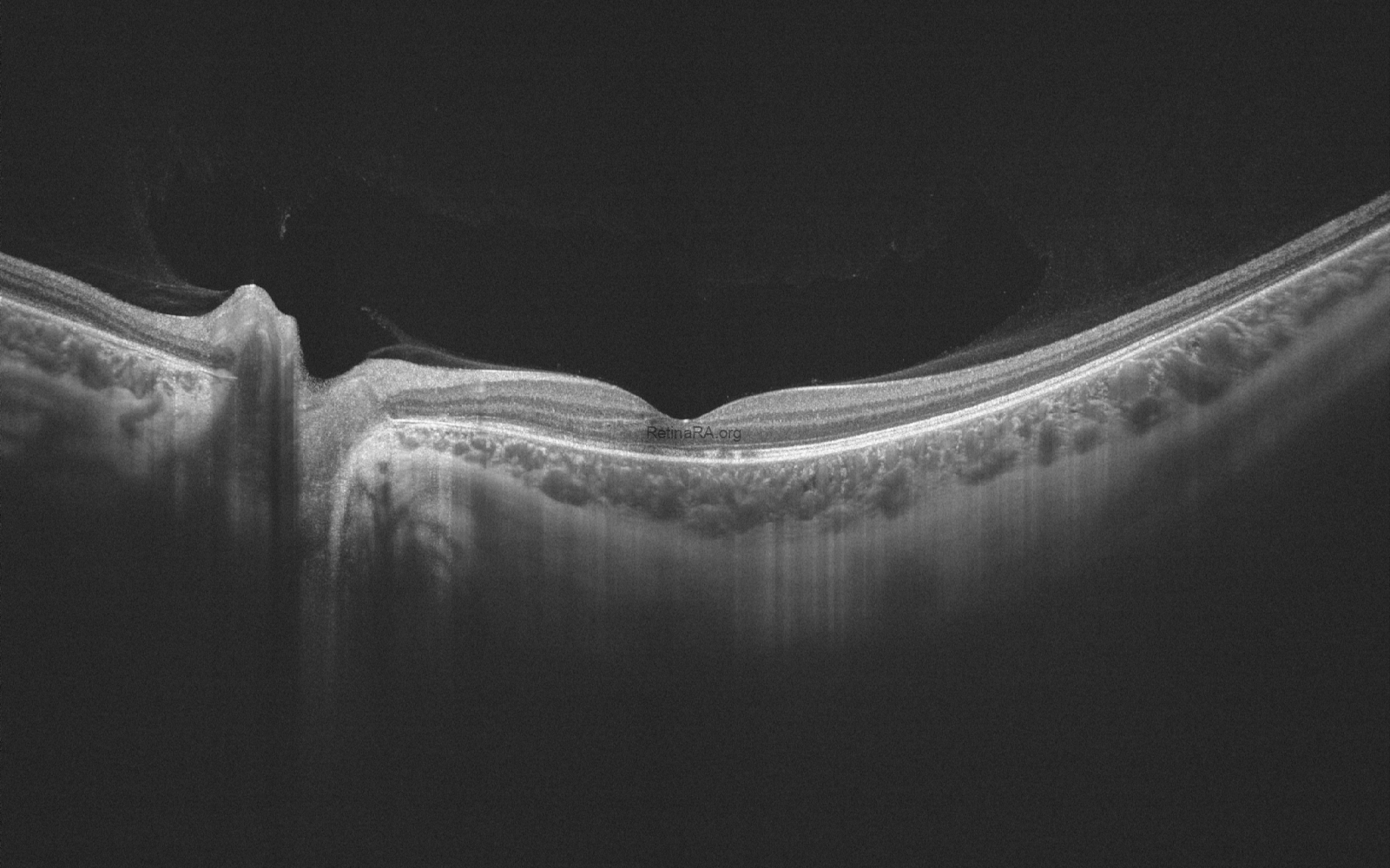 punctate-inner-choroidopathy-CNV-OCT-2wT8lOLY