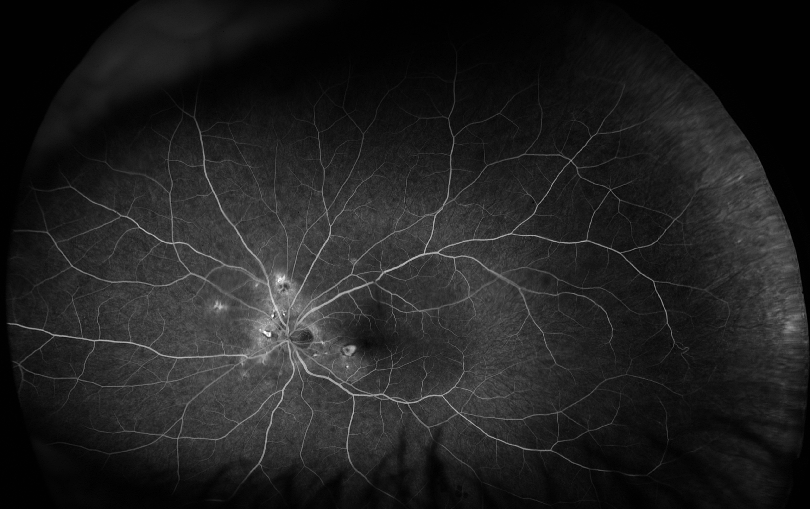 punctate-inner-choroidopathy-FA-2