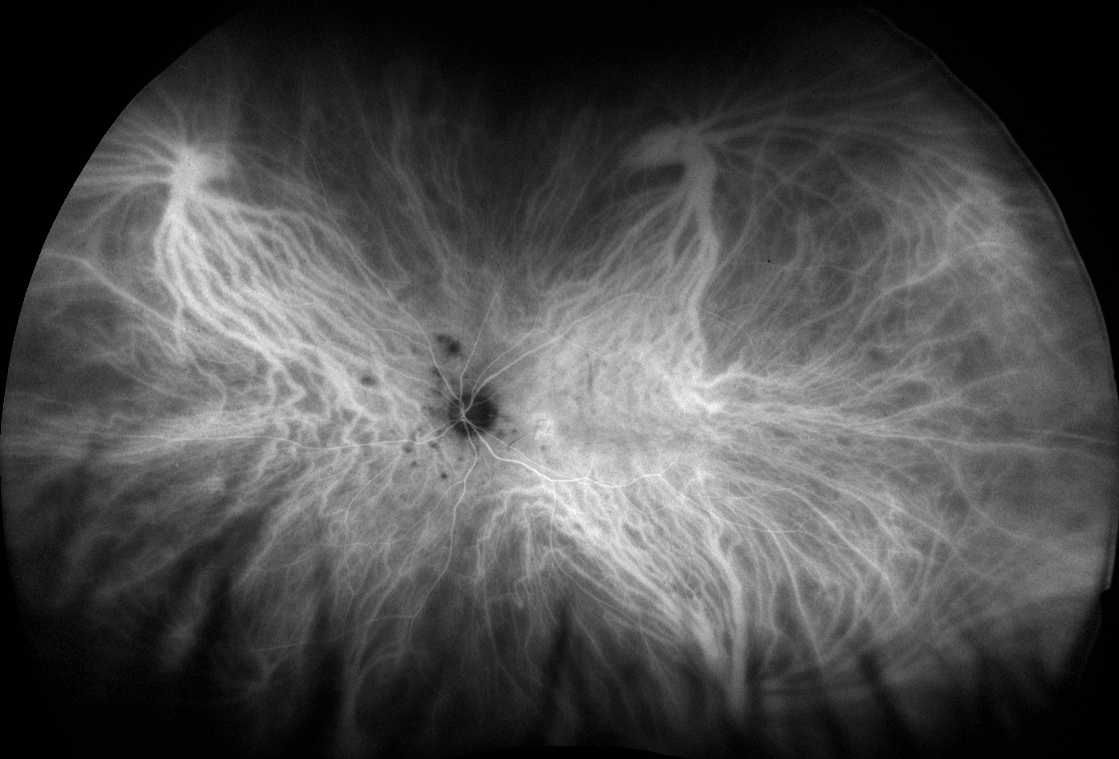punctate-inner-choroidopathy-ICG-3