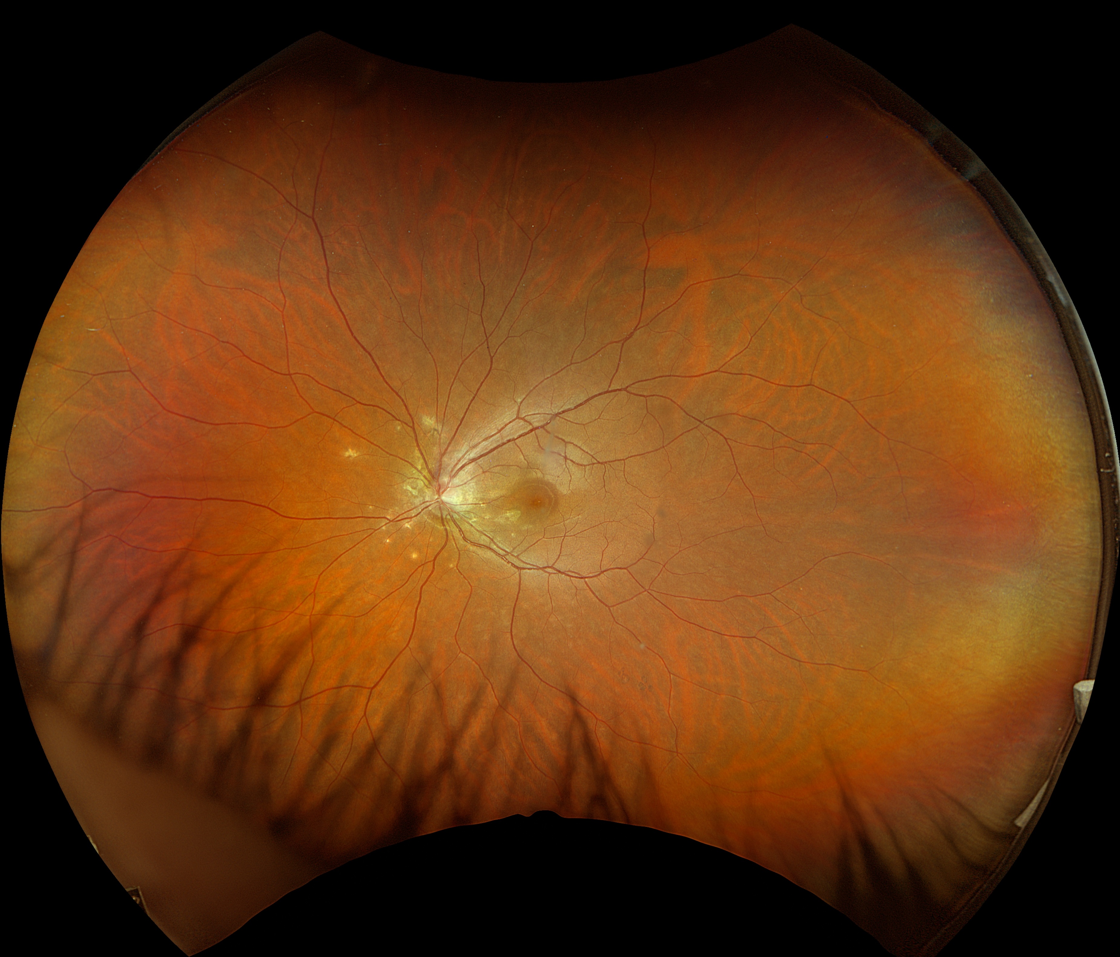 punctate-inner-choroidopathy-color-photography-4