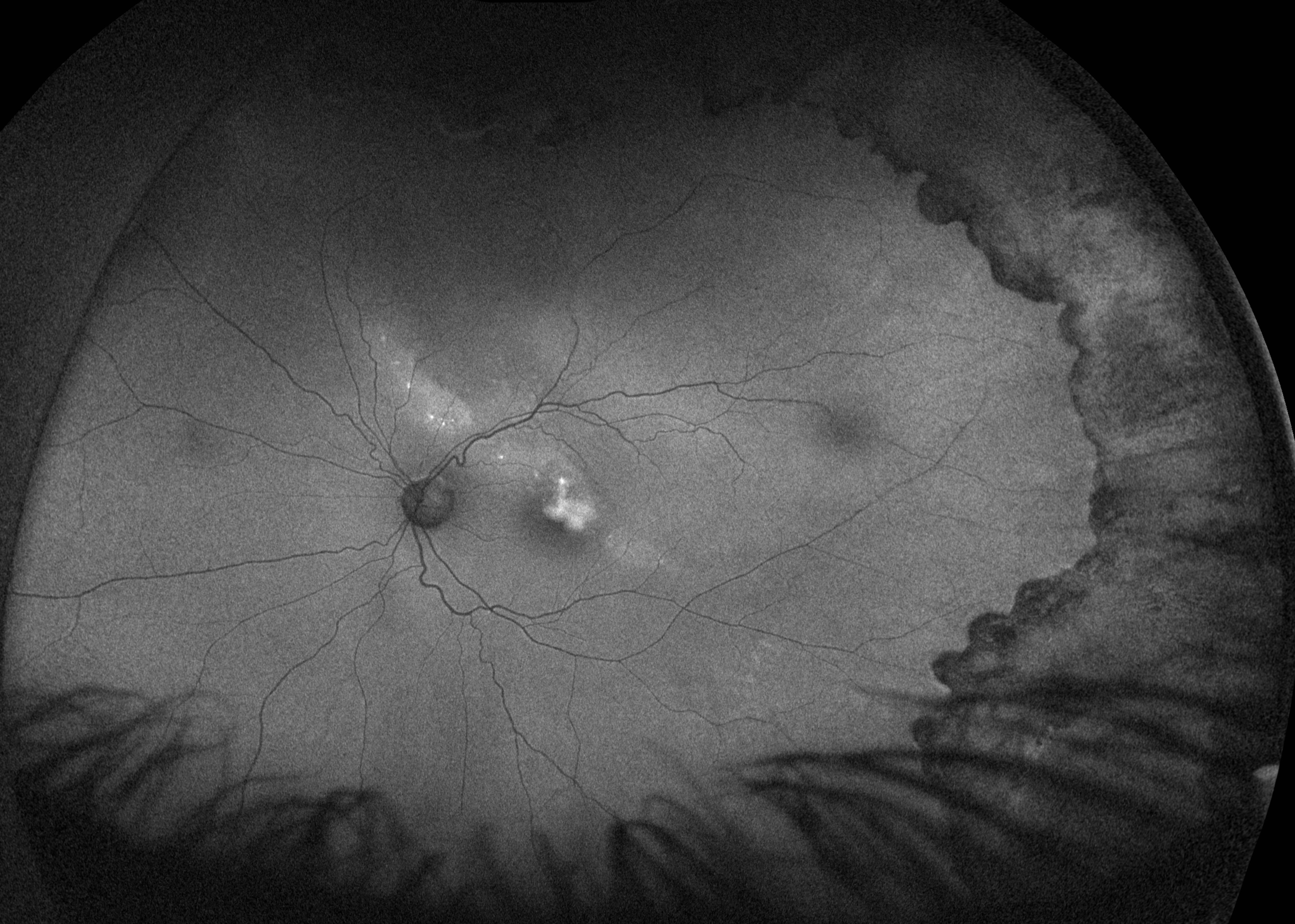 autoluorescence-image-residuel-subretinal-fluid-after-pneumatic-retinopeksi-for-rhegmatogenaus-retinal-detachment-2