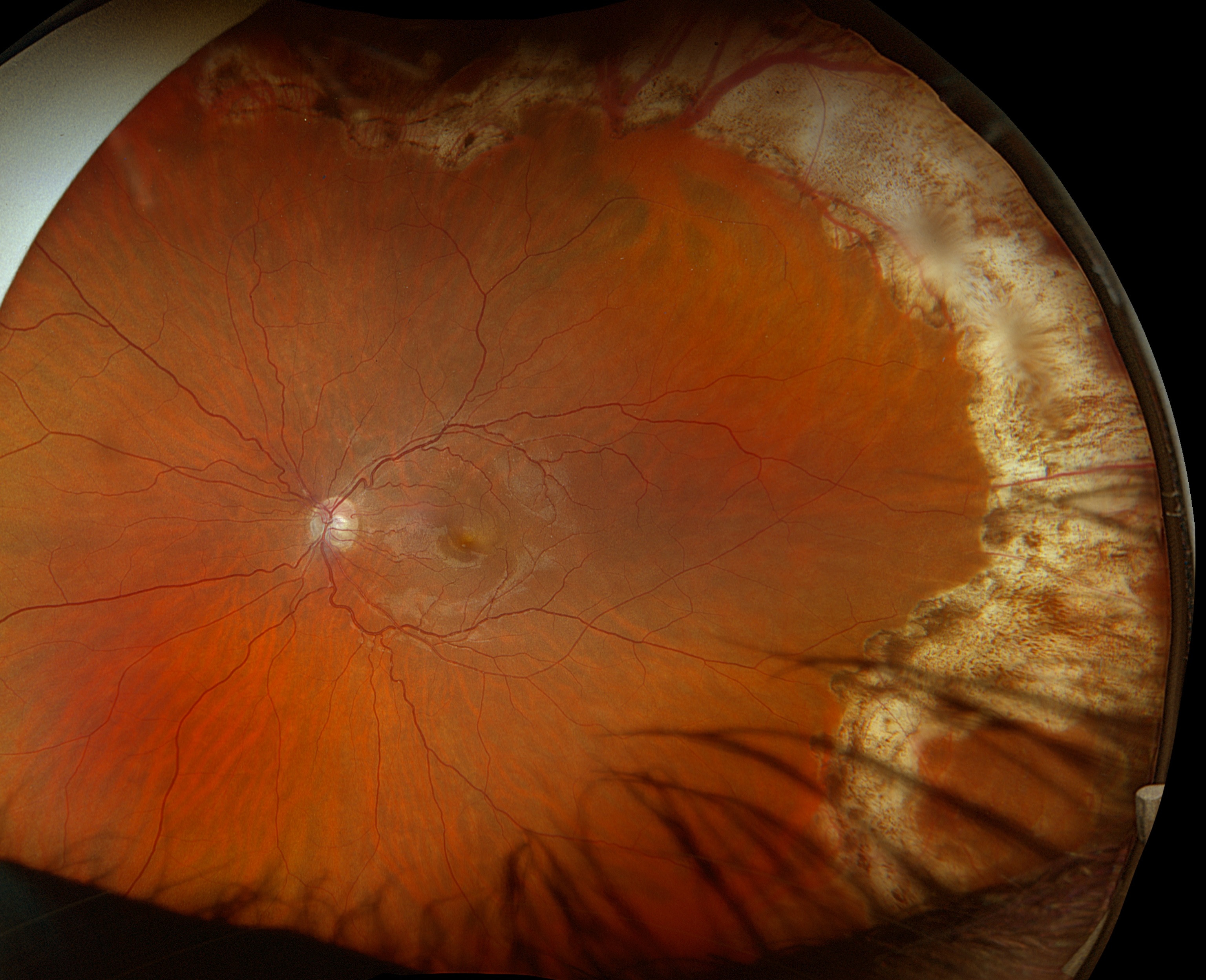 color-photography-residuel-subretinal-fluid-after-pneumatic-retinopeksi-for-rhegmatogenaus-retinal-detachment-1