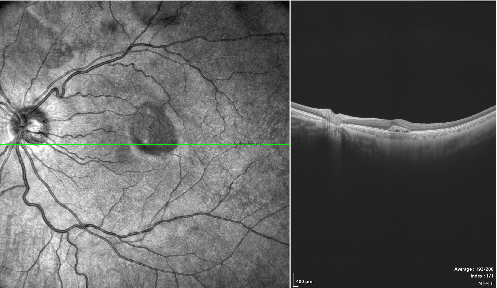 oct-residuel-subretinal-fluid-after-pneumatic-retinopeksi-for-rhegmatogenaus-retinal-detachment-1