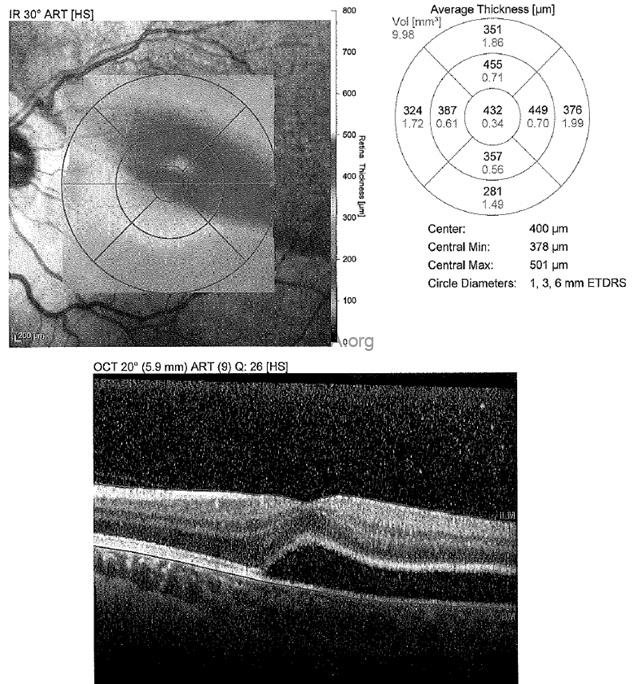 postoperative-oct