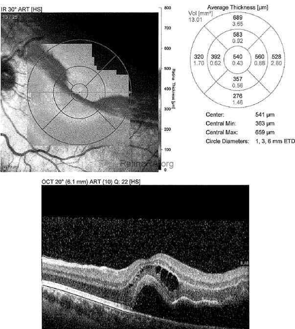 preoperative-oct