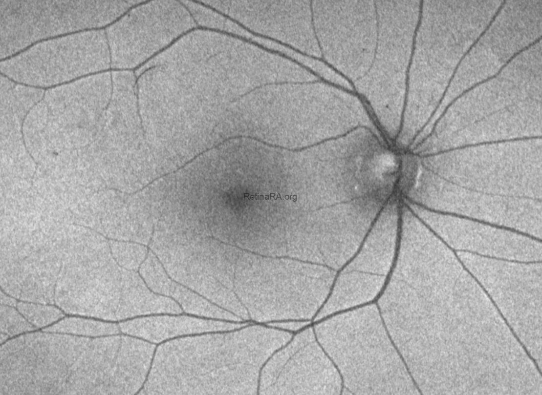 pachychoroid-pigment-epitheliopathy-AF