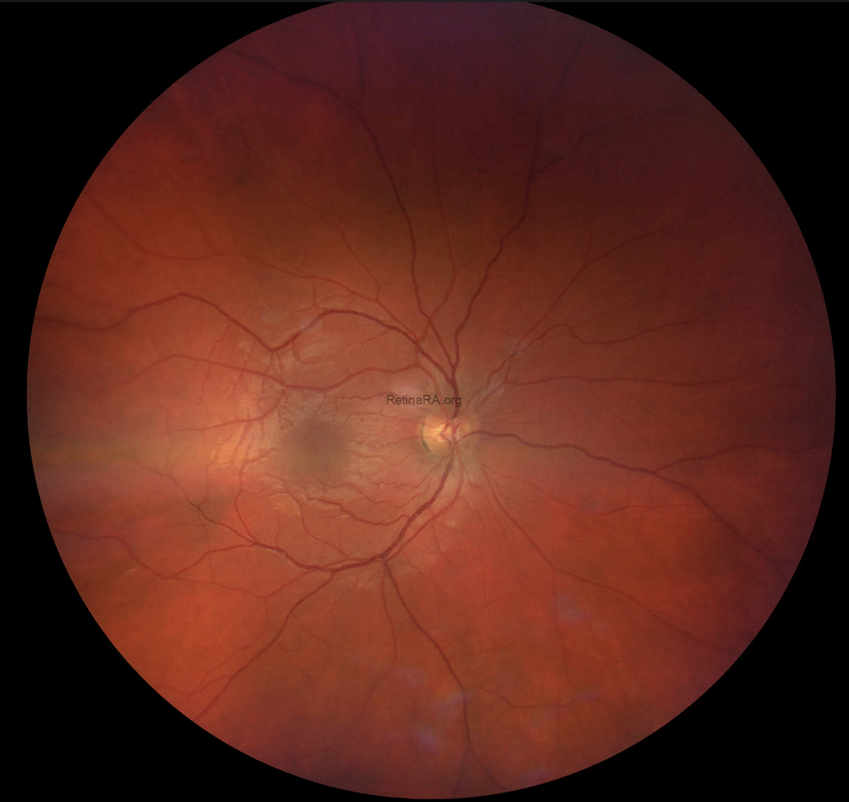 Fundus-OD