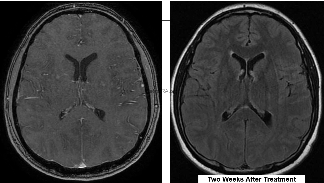 MRI-before-Treatment-and-after-TreatmentUdBf4lP