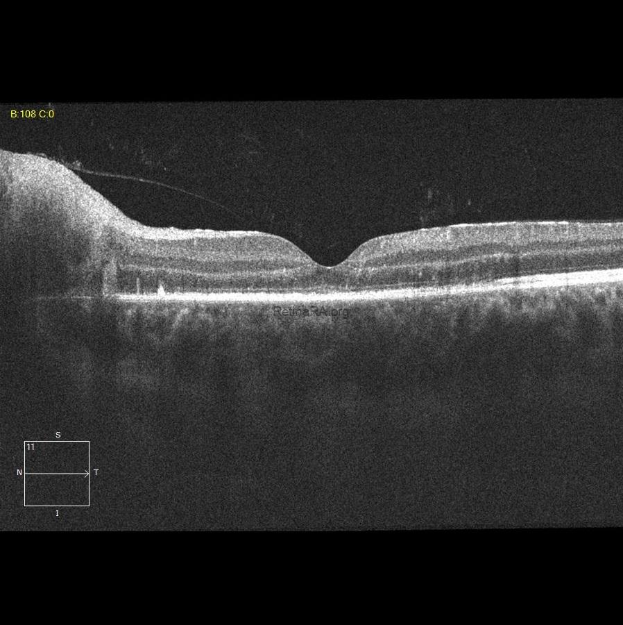 Severe-Bartonella-Neuretinitis-13th-day-1