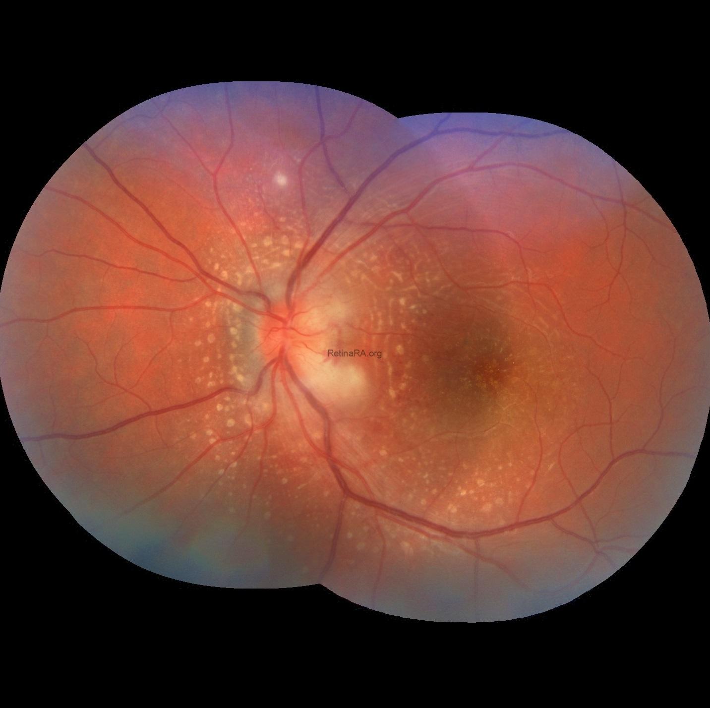 Severe-Bartonella-Neuretinitis-13th-day-1