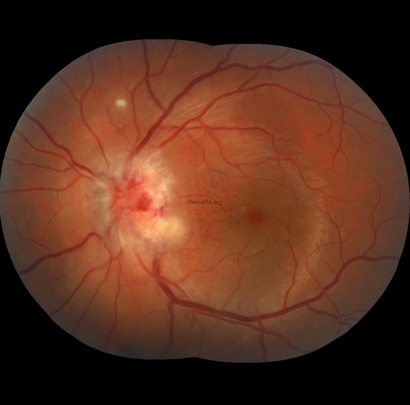 Severe-Bartonella-Neuretinitis-1st-day-2