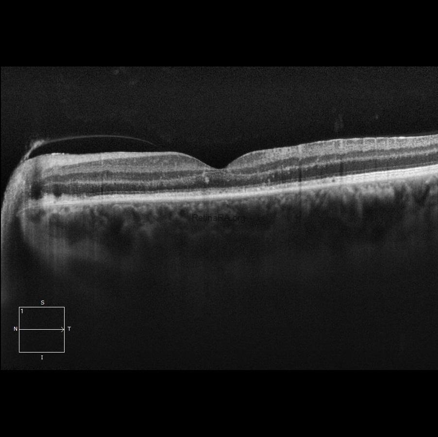 Severe-Bartonella-Neuretinitis-30th-day