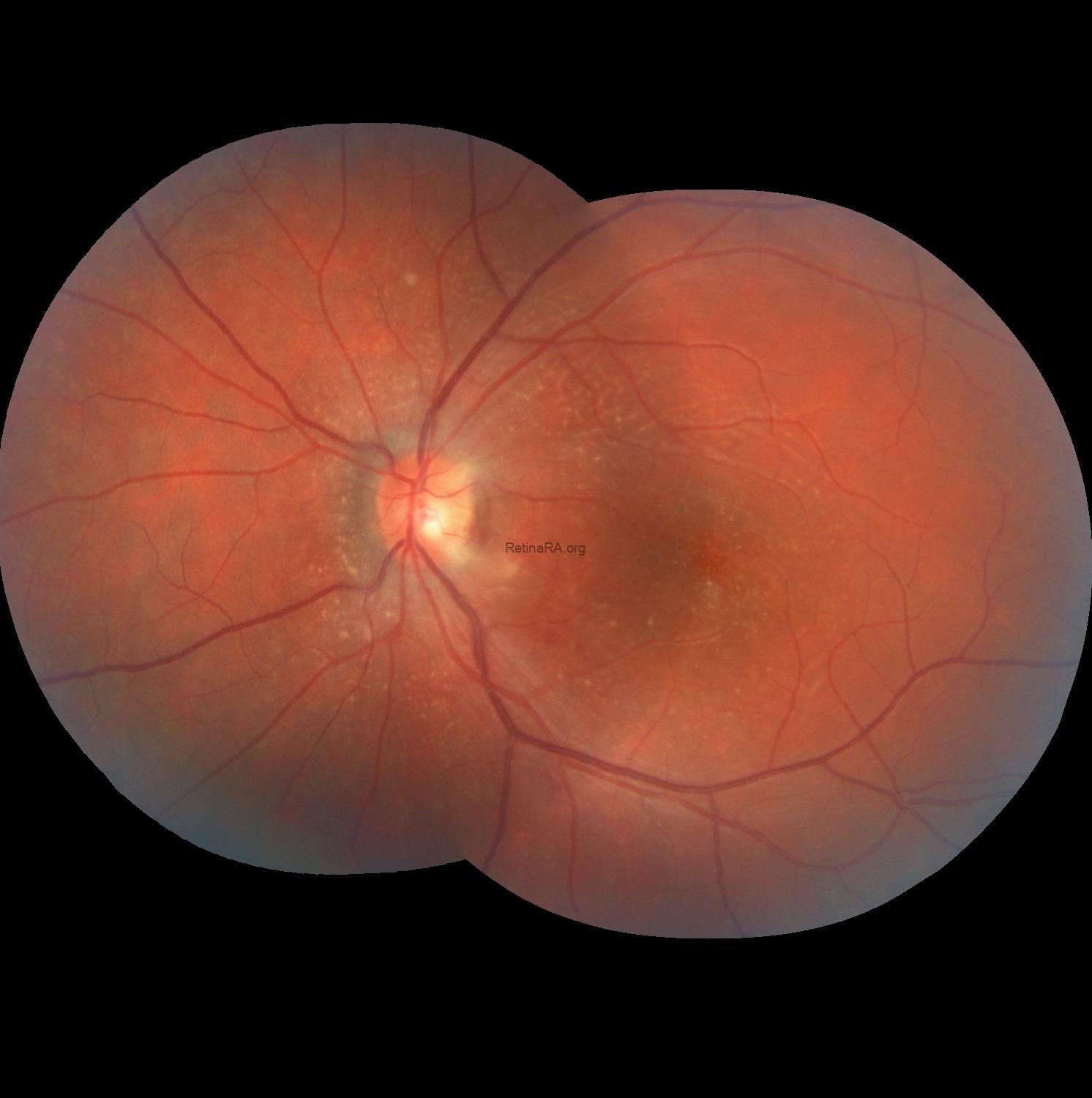 Severe-Bartonella-Neuretinitis-30th-day