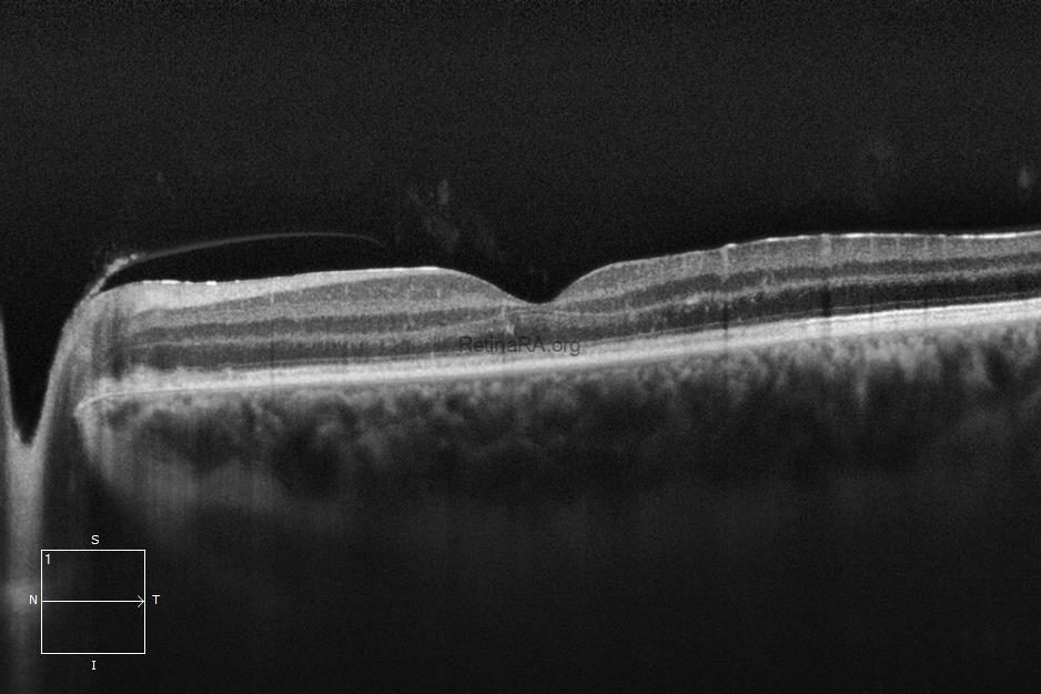 Severe-Bartonella-Neuretinitis-45th-day
