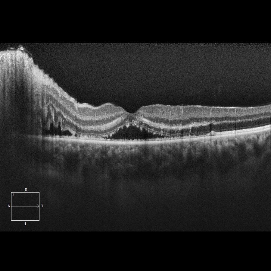 Severe-Bartonella-Neuretinitis-4th-day